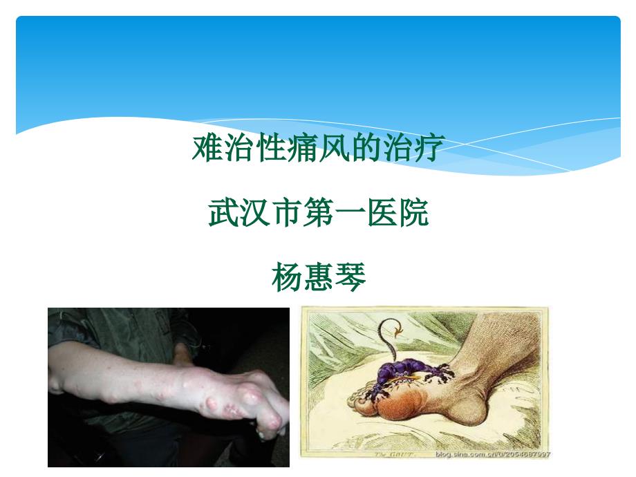 难治性痛风治疗杨惠琴_第1页