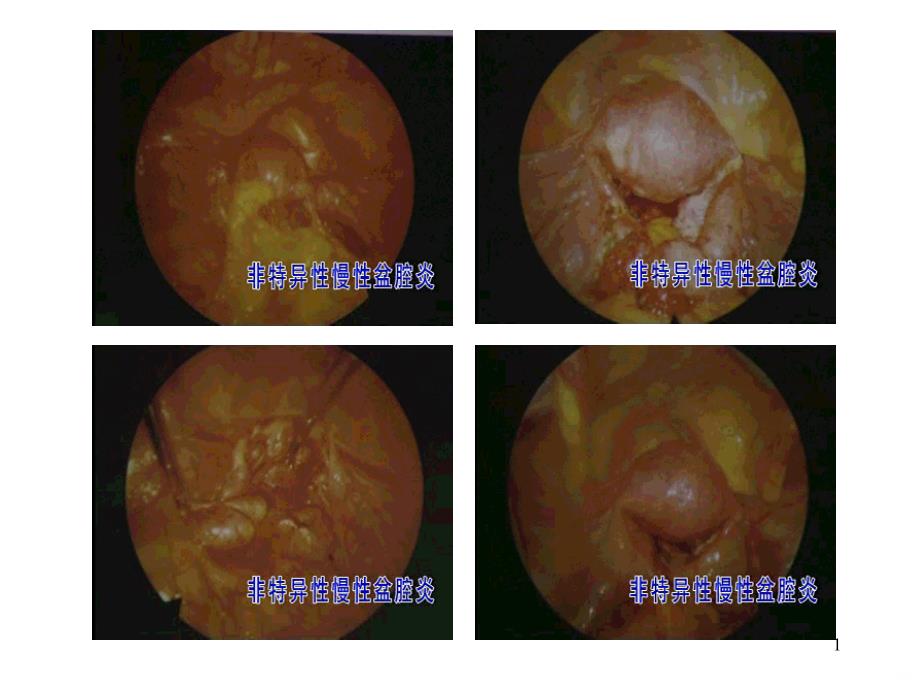 妇科疾病图片课件_第1页